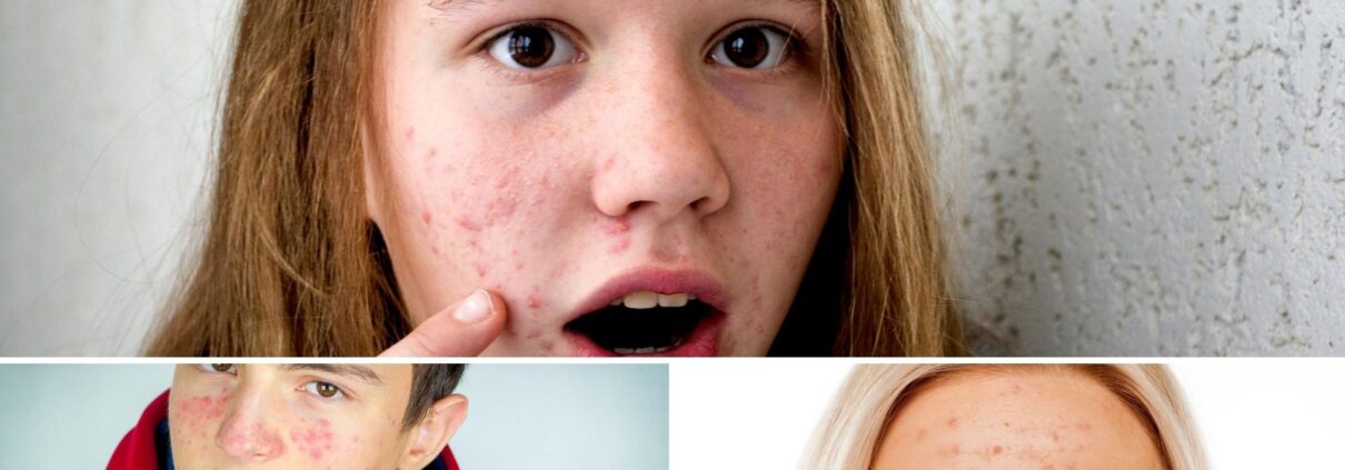 ACNE NO JOVEM