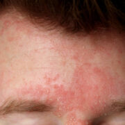 dermatite seborreica na face