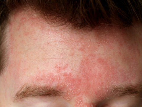 dermatite seborreica na face